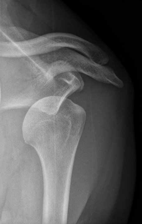 My shoulder